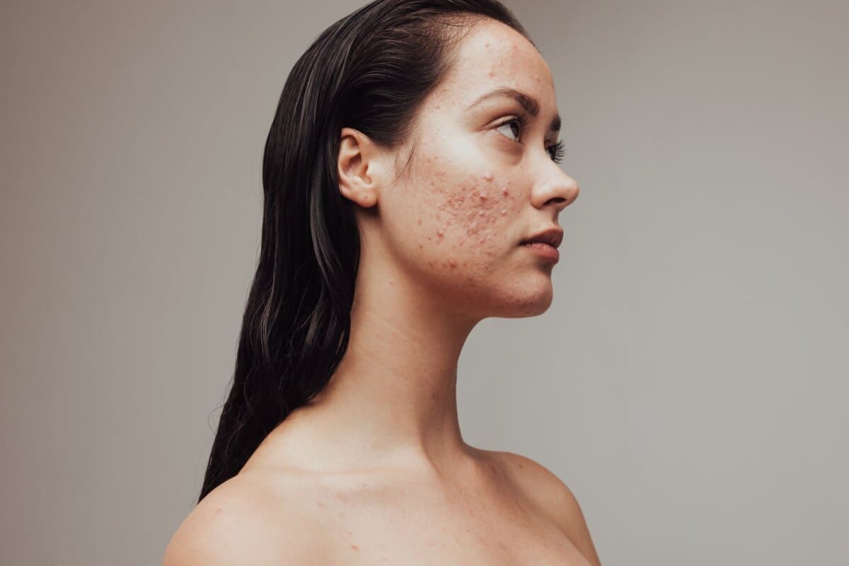 Seitliches Porträt einer Frau mit Akne – Nahaufnahme, die die Belastung durch Hautprobleme sichtbar macht.