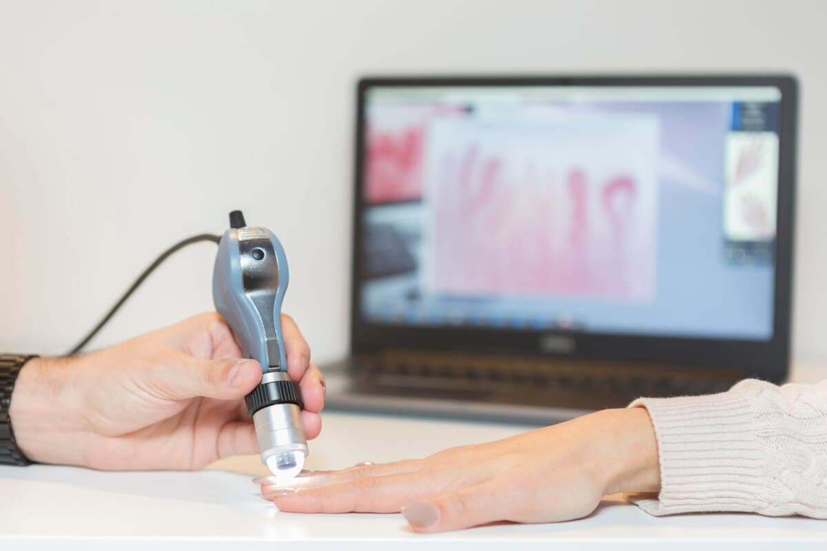 Videokapillarmikroskopie der Nagelfalz – Arzt untersucht die Mikrozirkulation zur Diagnostik der systemischen Sklerose.