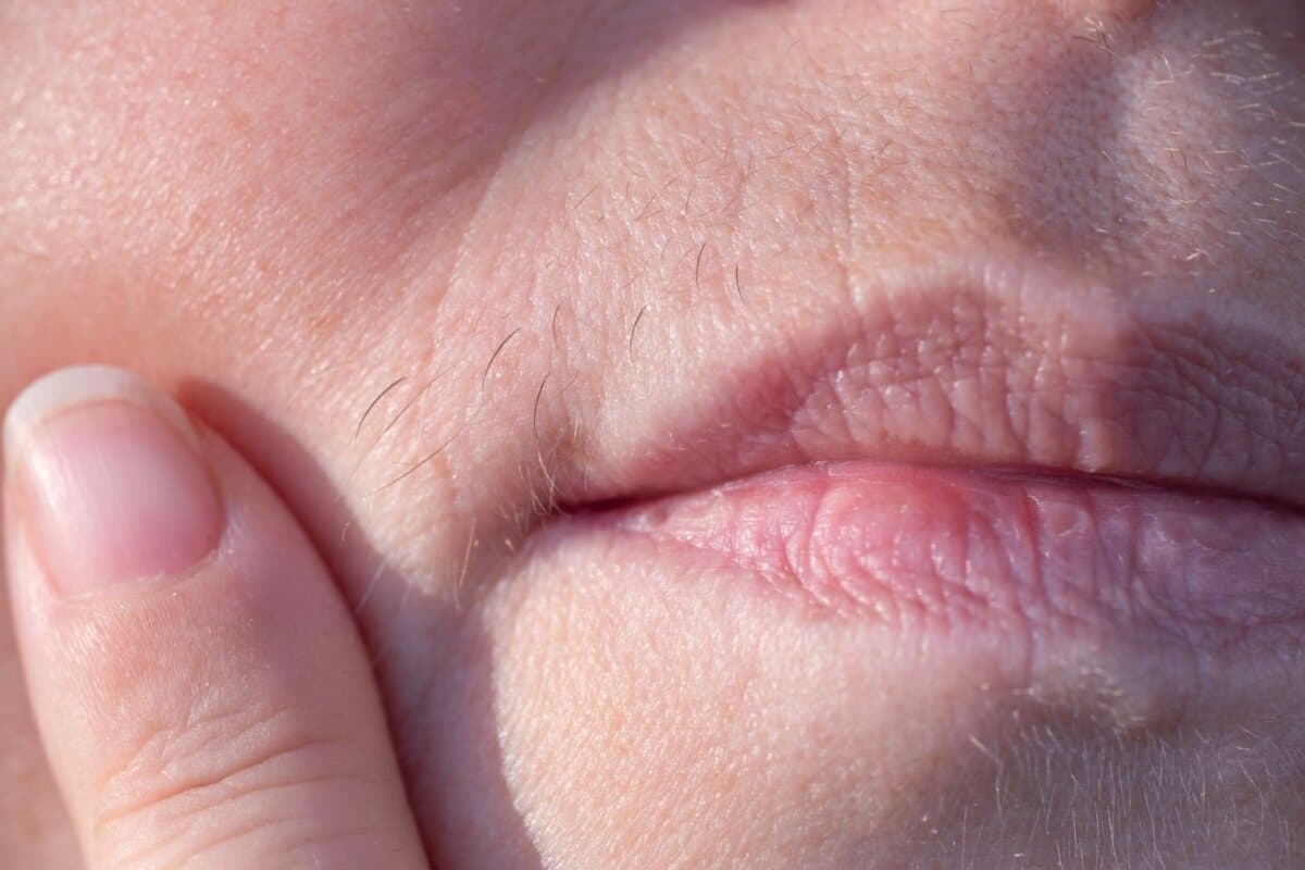 Gesichtsbehaarung bei PCOS: Ausdruck erhöhter Androgenspiegel