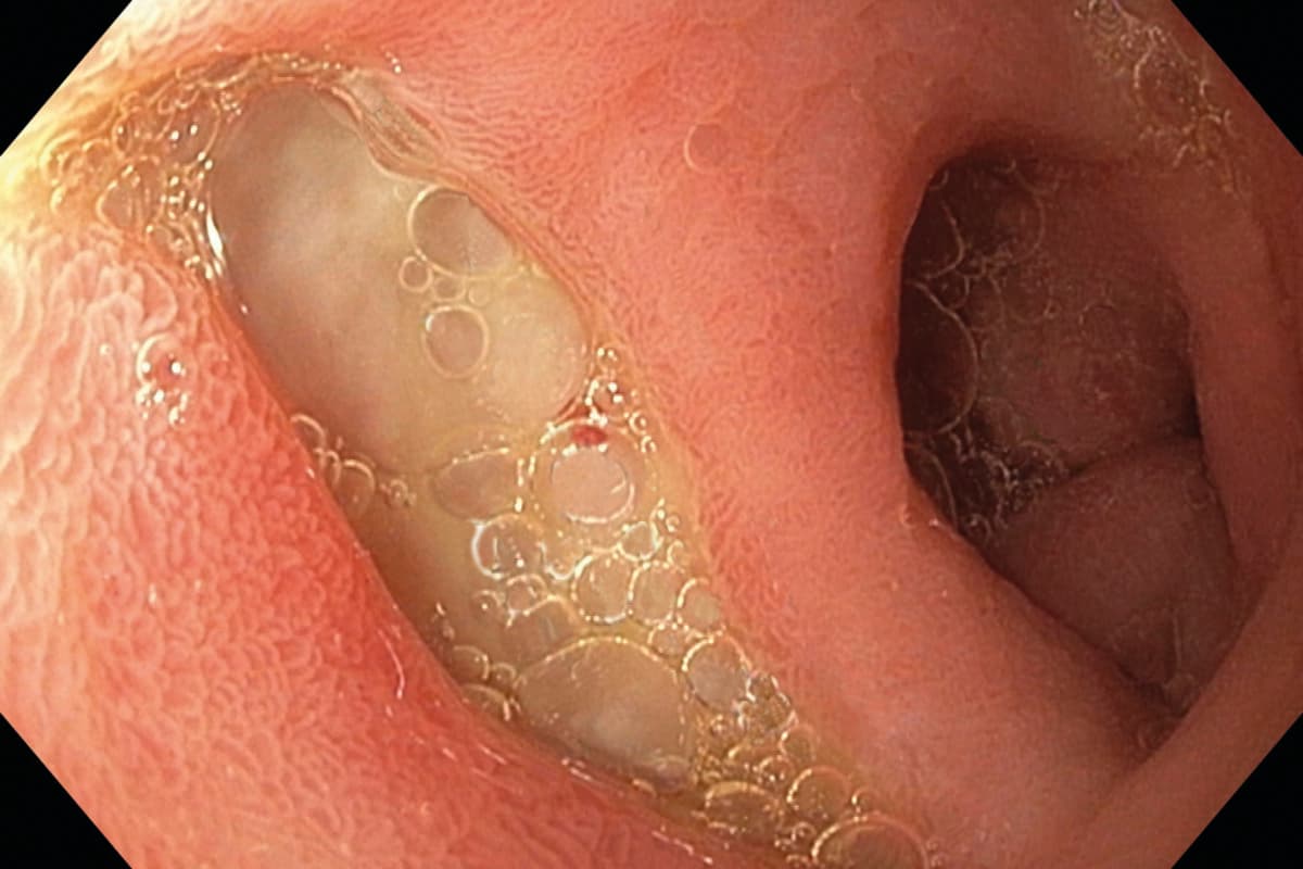 Koloskopische Aufnahme einer eitrigen Divertikulitis: Entzündete Divertikel im Kolon mit sichtbarer Pusansammlung.