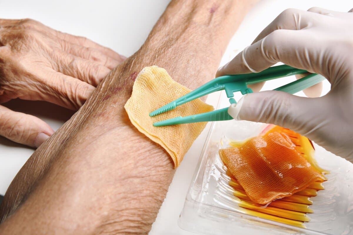 Reinigung und Versorgung einer infizierten chronischen Wunde bei einem älteren Menschen mit Diabetes.