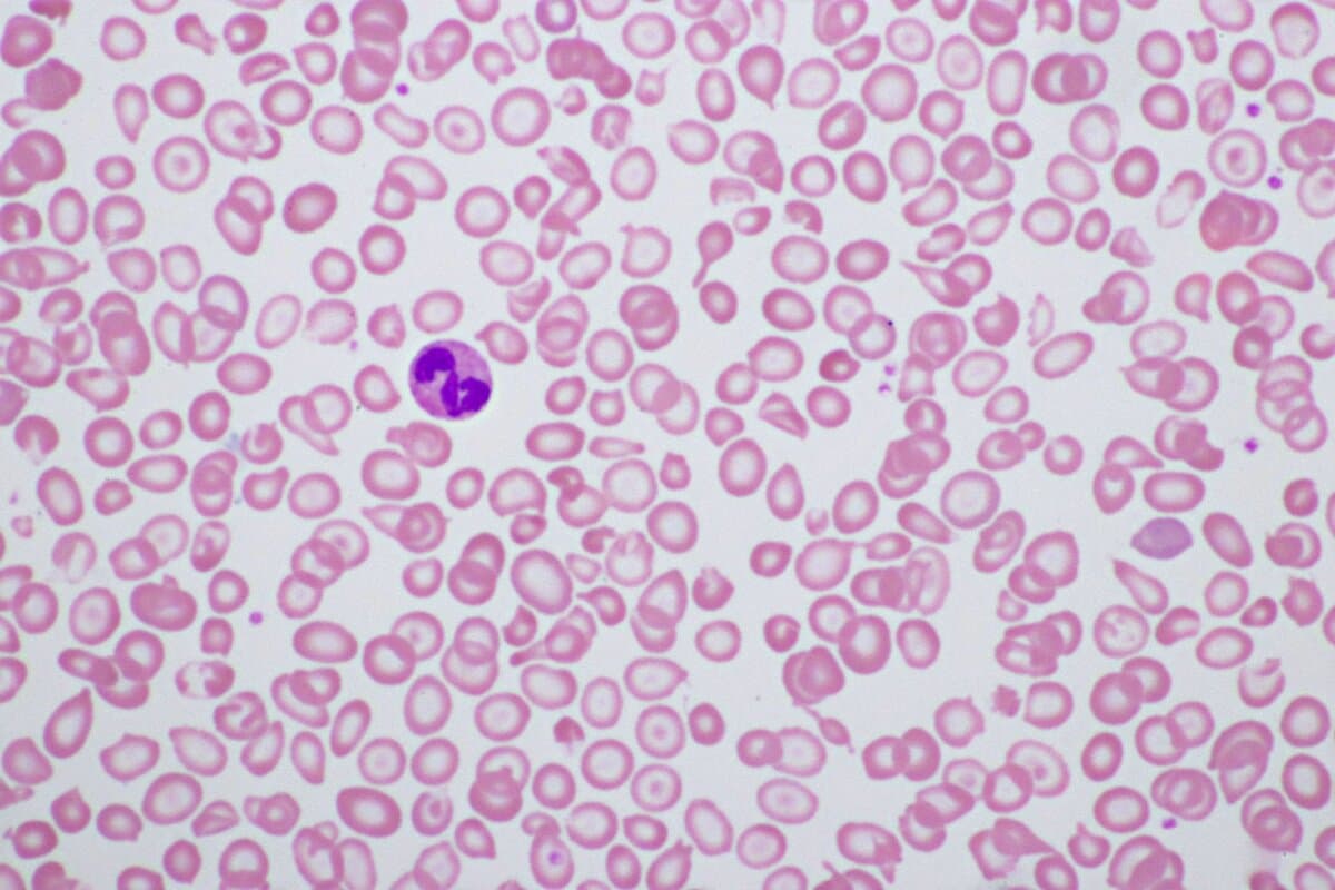 Abnormale Erythrozyten eines Thalassämie-Patienten