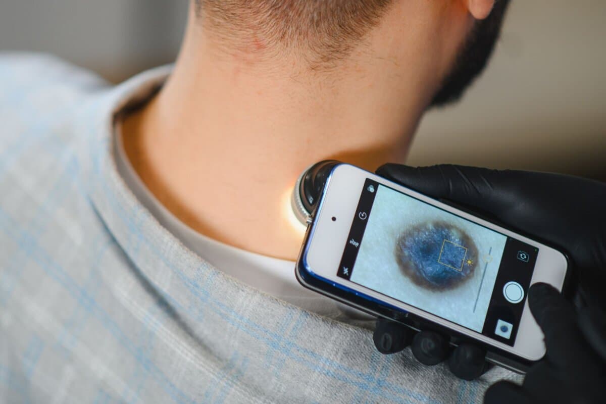 Ärztliche Untersuchung eines Muttermals am Hals mittels Smartphone-Aufsatz zur Früherkennung von Melanomen und anderen