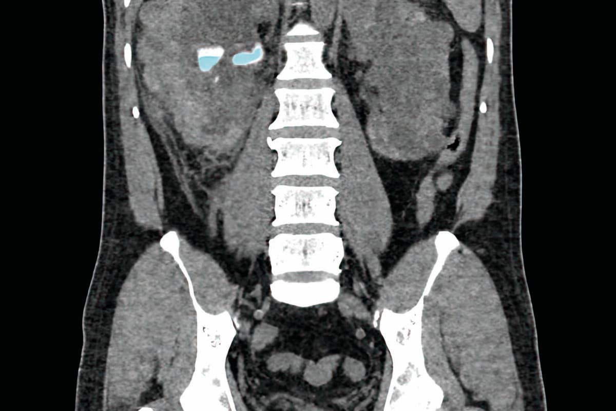 Coronal CT Scan of the Abdomen Showing Renal Stone in the Left K