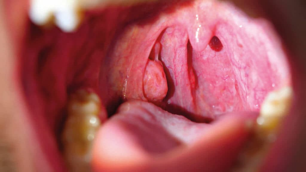 Patient With Sore Throat Examination of Strep Throat and Adenoids