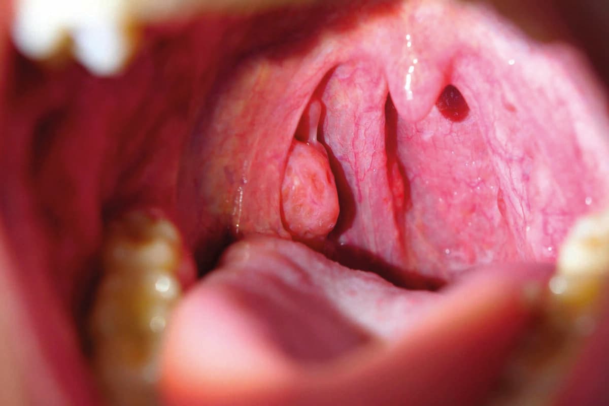 Patient With Sore Throat Examination of Strep Throat and Adenoids