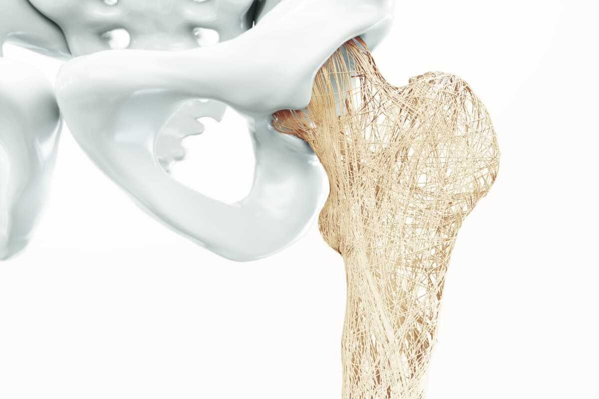 Illustration der Osteoporose