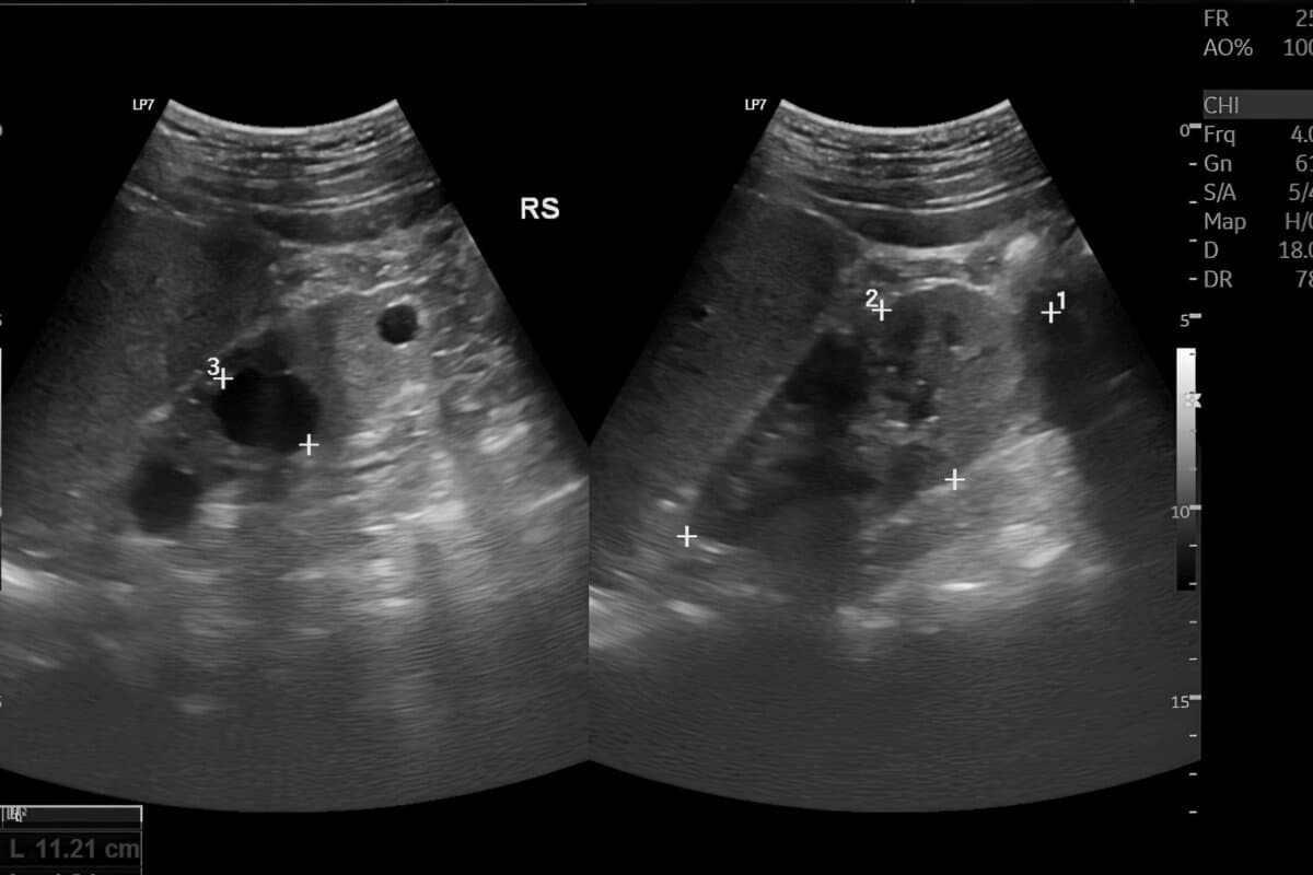 Sonografische Darstellung multipler Gallenblasensteine (Cholezystolithiasis).