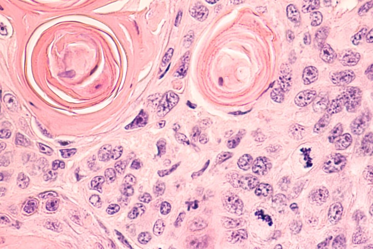 Lungenkarzinom: Histologischer Schnitt einer CT-gesteuerten Stanzbiopsie mit Nachweis eines pulmonalen