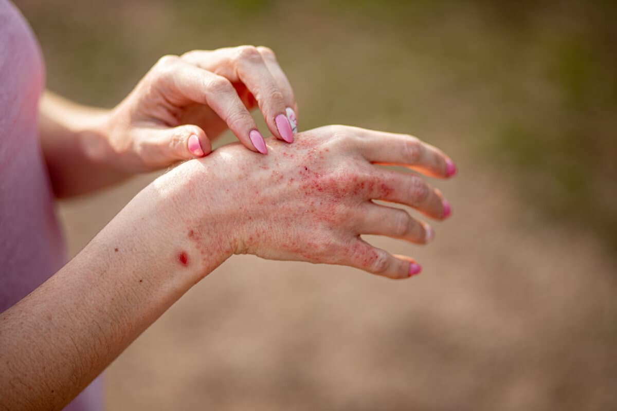 Gros plan d’une peau atteinte de dermatite atopique avec lésions eczémateuses caractéristiques.