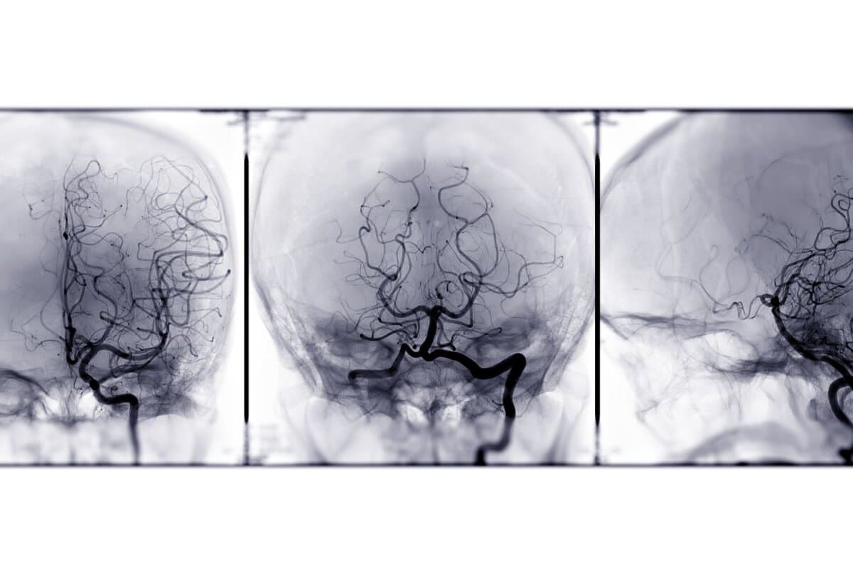 3D-Darstellung der zerebralen Gefässe in verschiedenen angiografischen Ansichten.