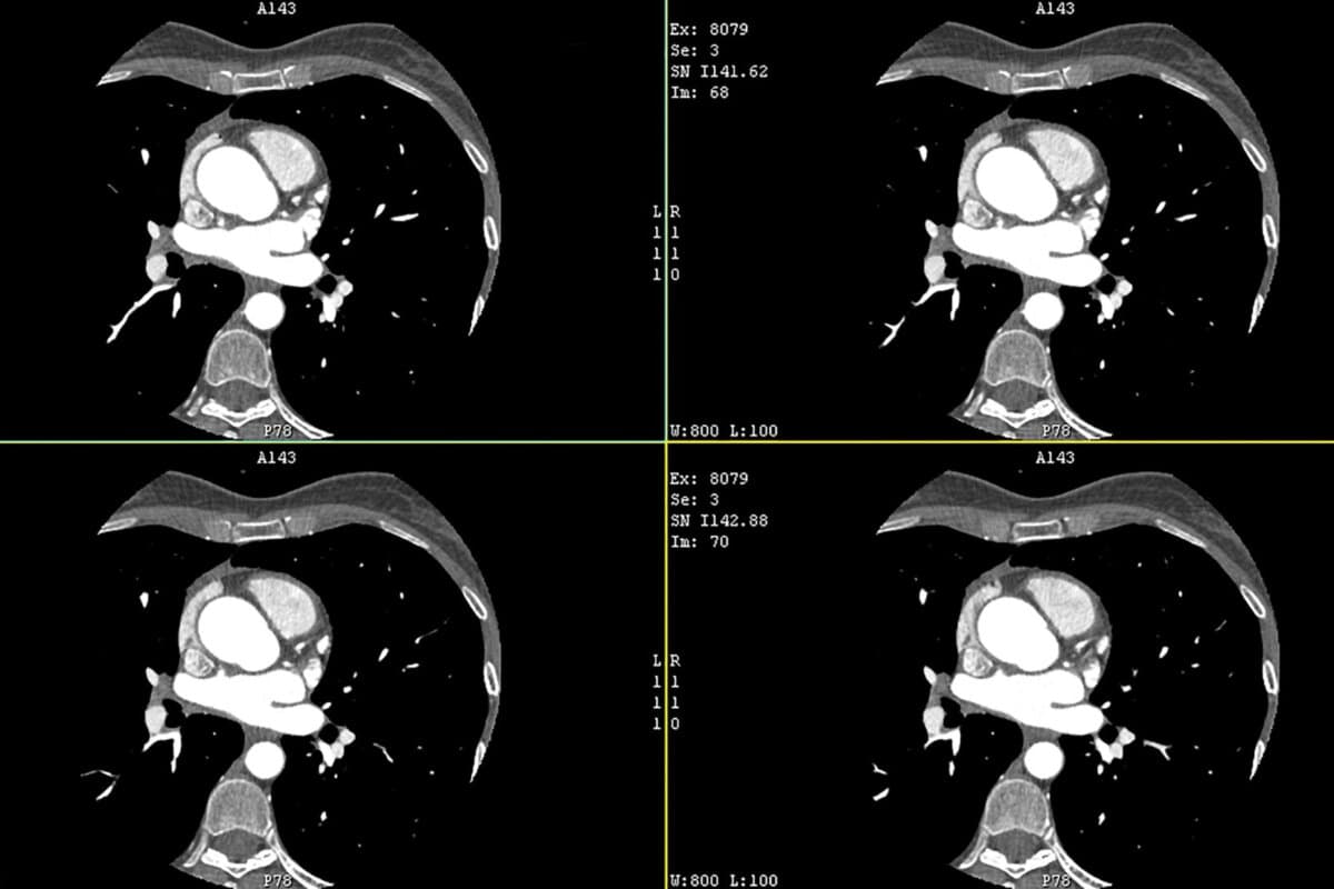 L’angiographie coronaire par CT permet une visualisation non invasive des artères coronaires