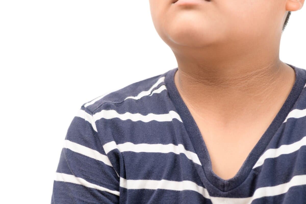 Acanthosis nigricans bei einem Jungen