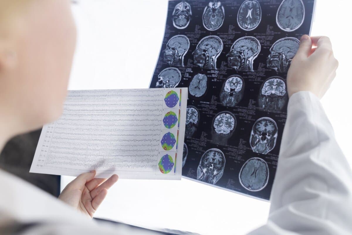 Epilepsie: Neurologe untersucht ein Patienten-MRI und EEG.