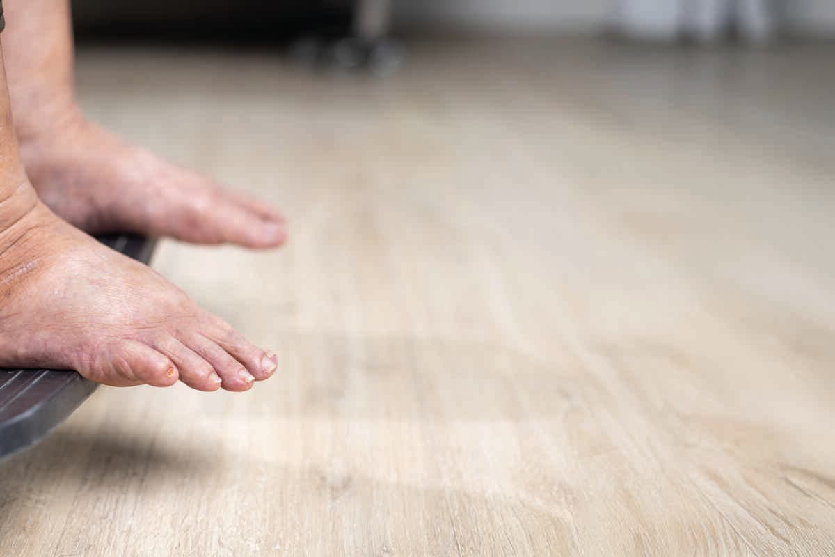 Elderly woman has edema or swelling foot.