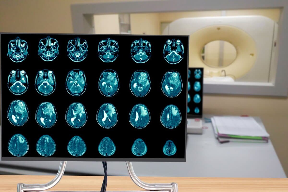 MRI des Gehirns