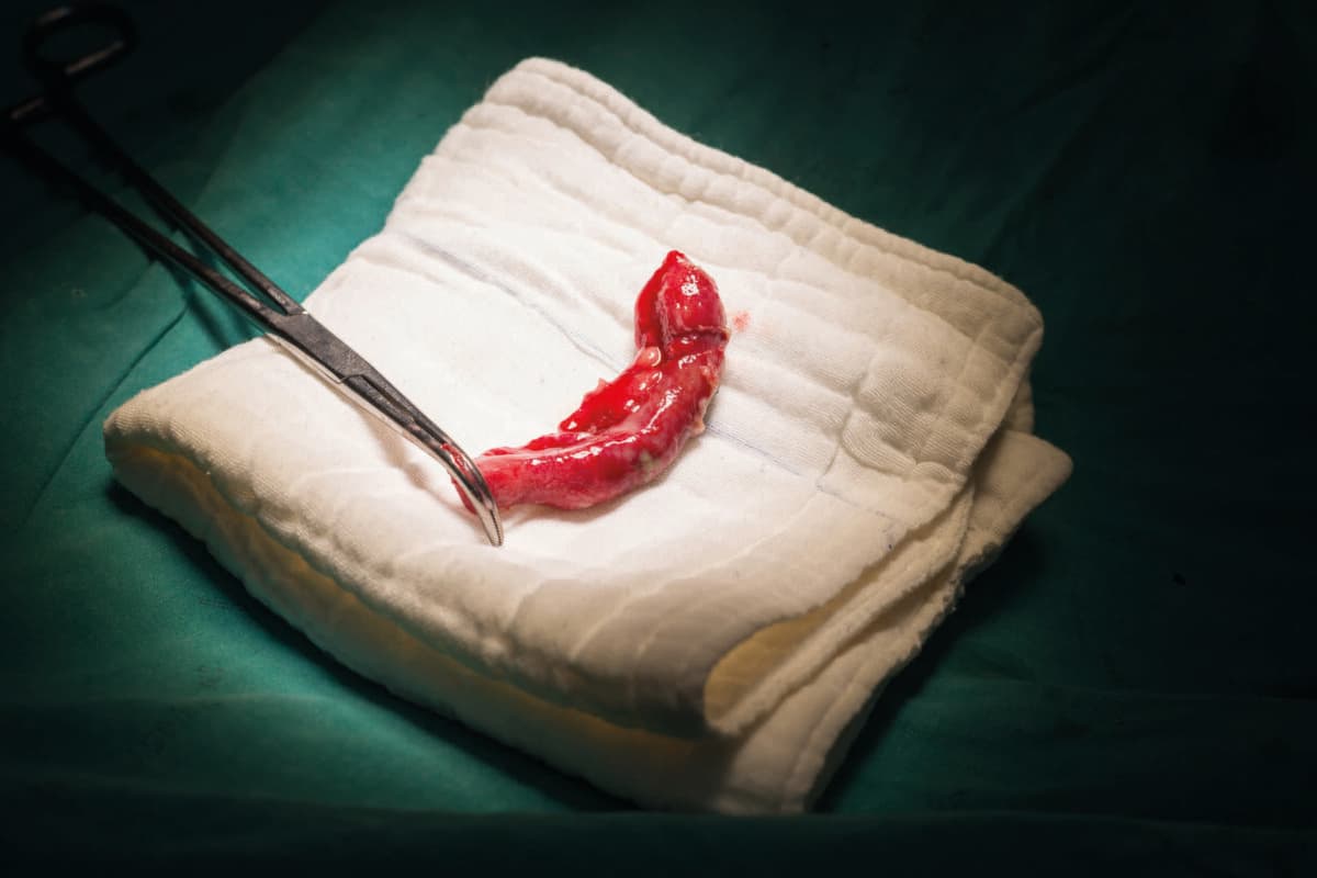 Appendix specimen from appendectomy