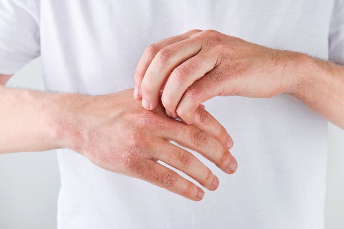 Eczéma des mains