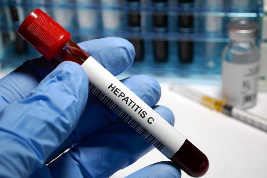 Mediziner hält eine Blutprobe mit Hepatitis c in der Hand