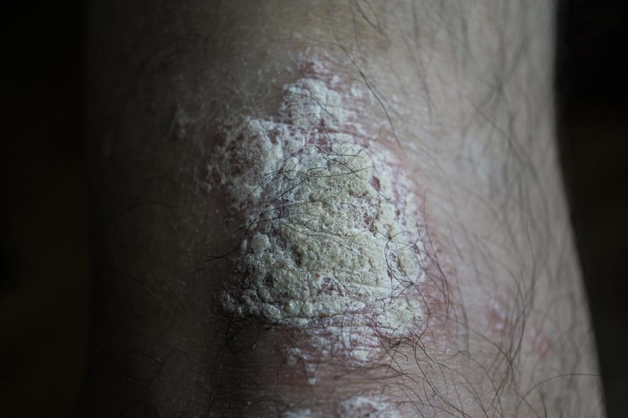 Plaque Psoriasis am Arm