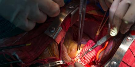 bentall&#8217;s operation in ascending aortic aneurysm
