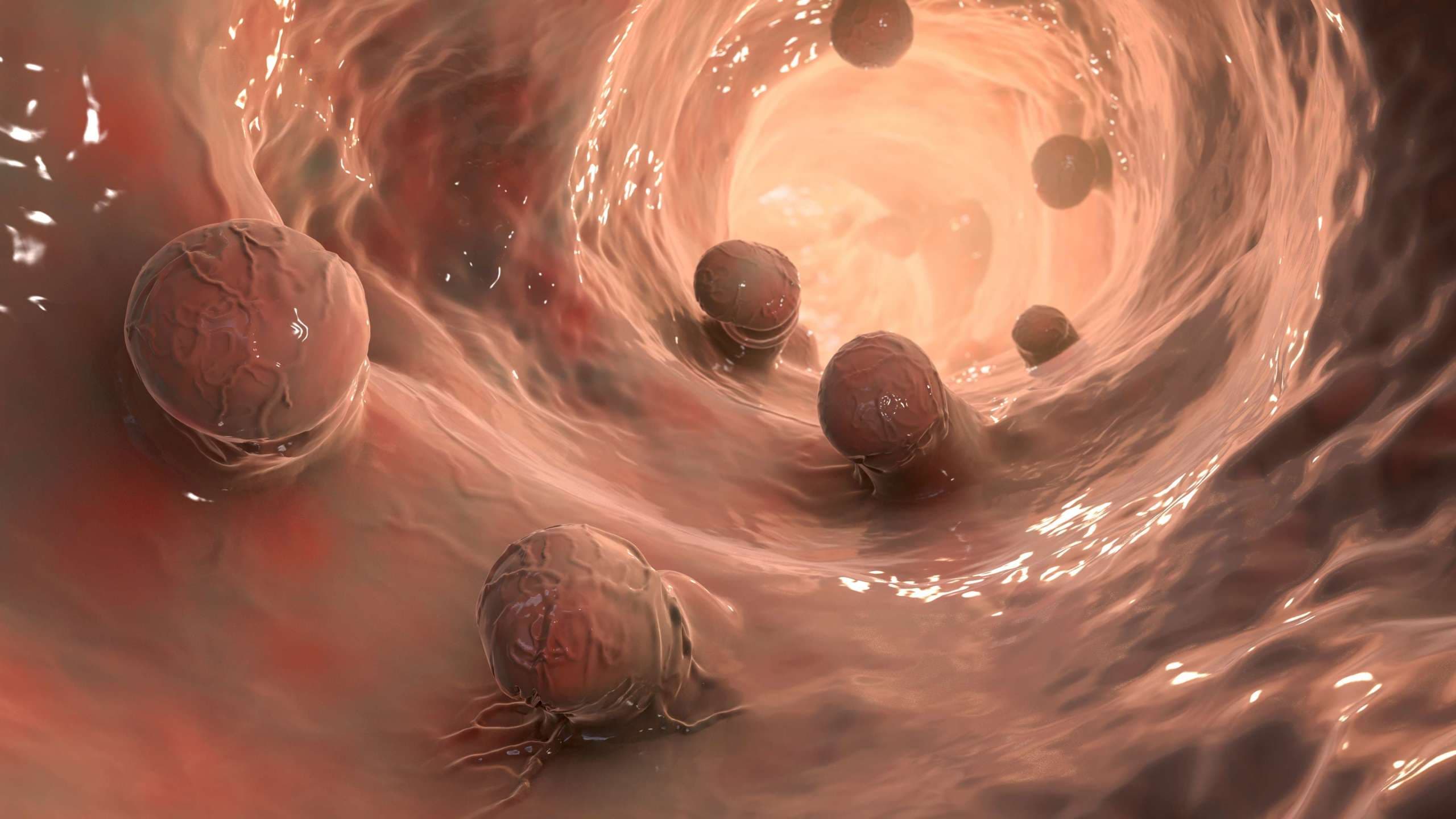 Darmpolypen, kolorektale Polypen, 3D-Darstellung mit zahlreichen polypösen Vorsprüngen an der Darmschleimhaut