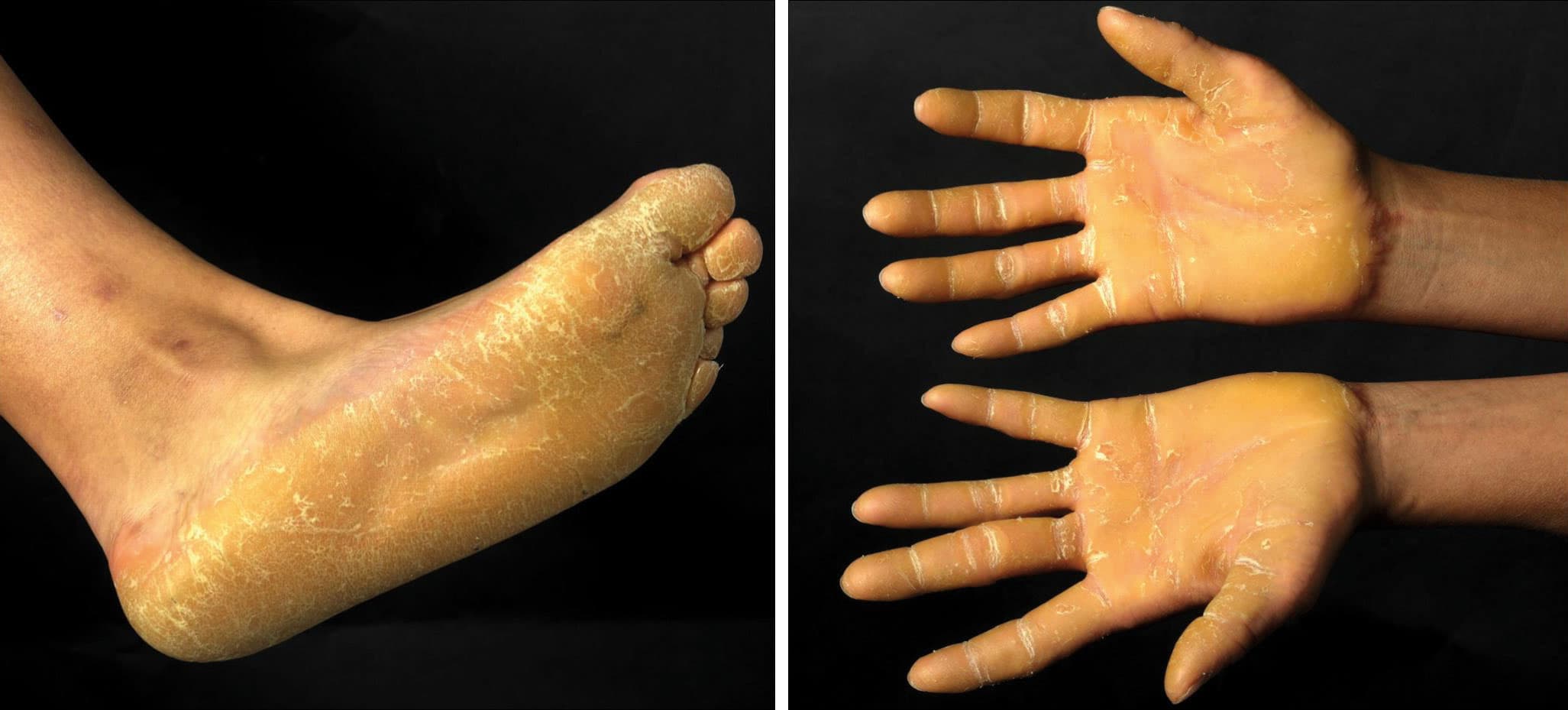 MO_AT_2022_KW13NL_Keratoderm_Hand_Fuss