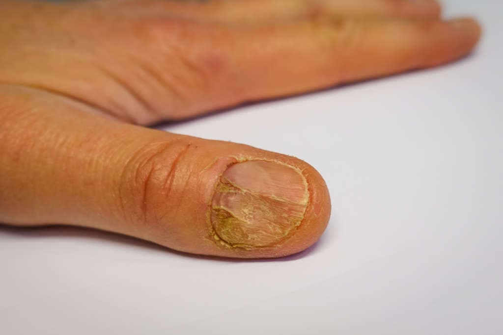 Die Nagelpsoriasis ist ein schlechtes prognostisches Zeichen.