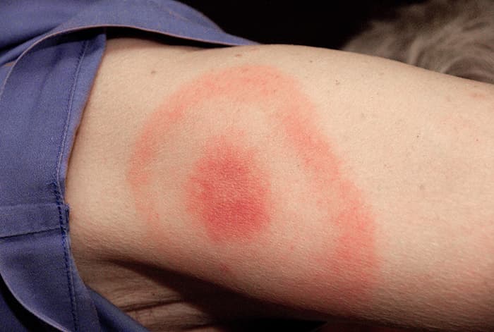 Ist die Wanderröte (Erythema migrans) nach einem Zeckenbiss zu sehen, kann man sich die Serologie vorerst sparen.