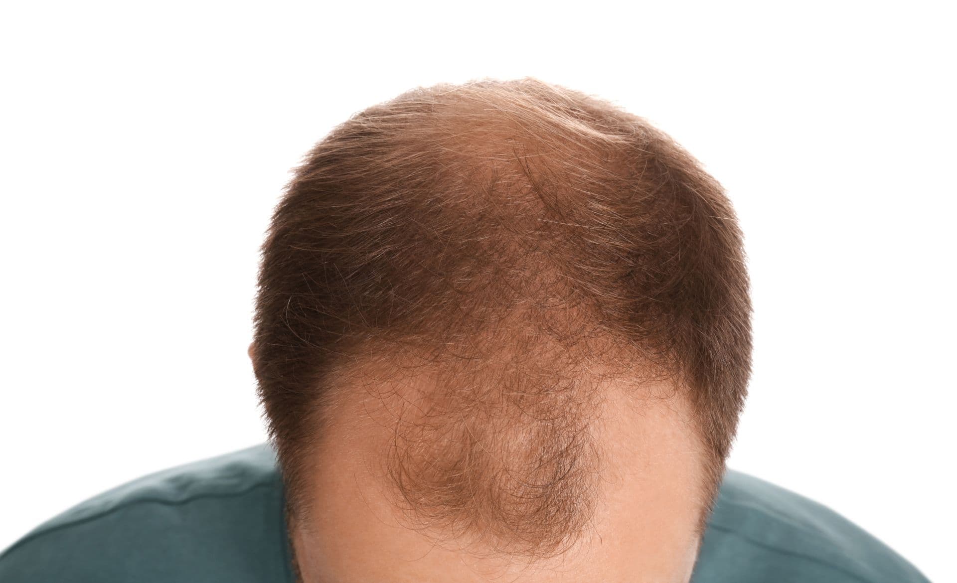 Der androgenetisch bedingte Haarverlust beginnt beim Mann typischerweise an den Schläfen, bei der Frau am Scheitel.