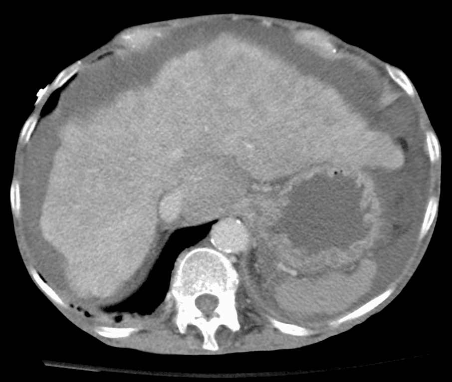 Bei Patienten mit Leberzirrhose und Aszites ist Humanalbumin wirksam und sinnvoll, zeigt eine aktuelle Studie. 