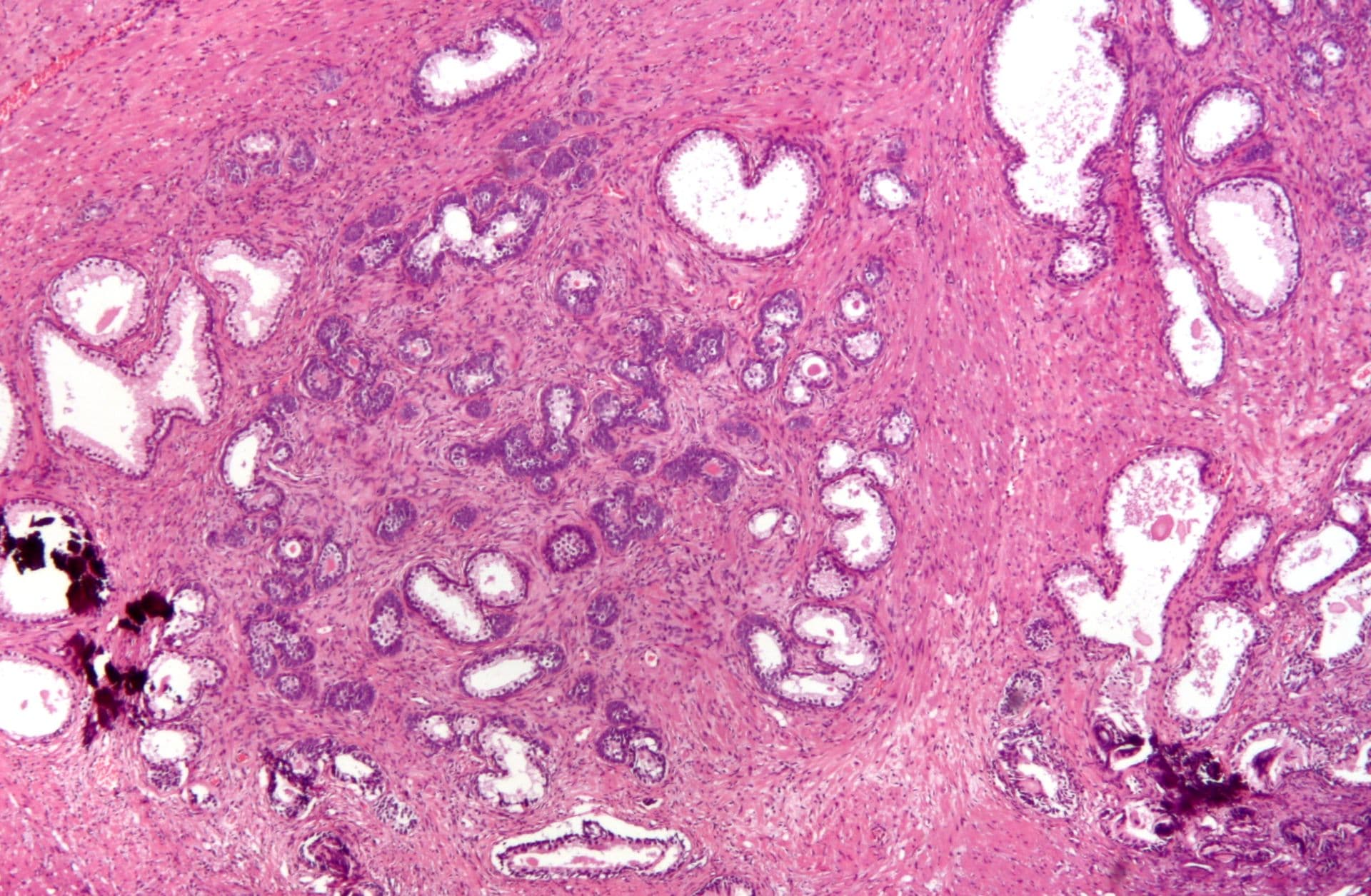 Die Aquablation steht der TUR-P um nichts nach. Reseziertes Prostatagewebe mit benigner Hyperplasie.
