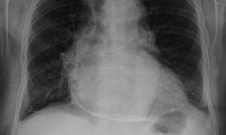 Roentgenbild eines Oberkörpers mit verdicktem und verkalktem Perikard bei Pericarditis constrictiva (auch Panzerherz oder Pericarditis calcarea)