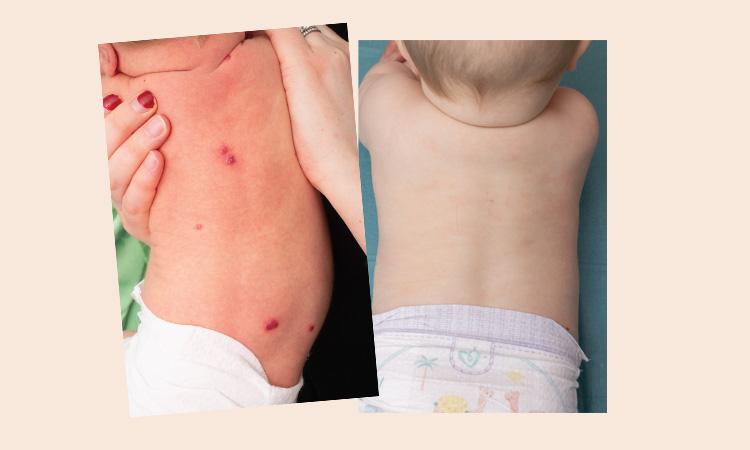 Vor und nach der Therapie: Baby mit Hämangiom