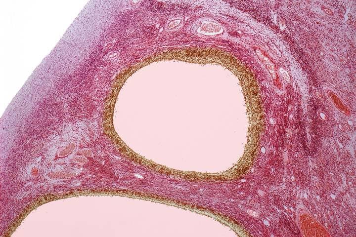 Mikroskopische Aufnahme eines histologischen Schnitts der Ovarialzysten bei einer PCOS-Patientin zeigt.