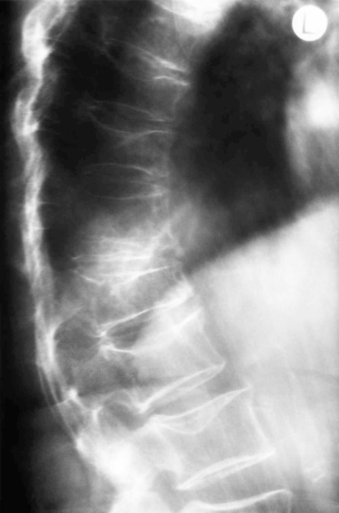 X-ray showing fractured spine due to osteoporosis