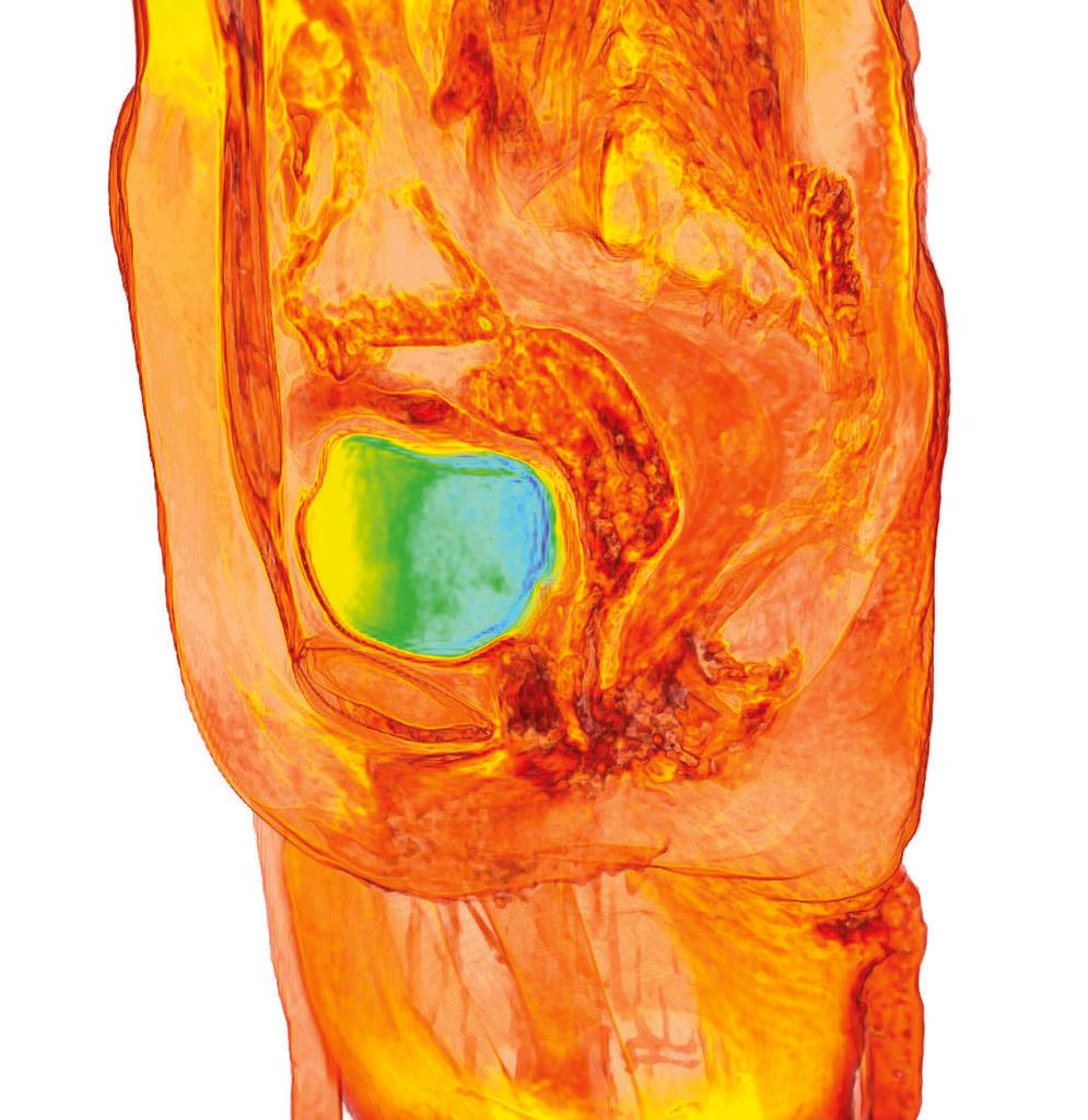 Female bladder, 3D MRI scan
