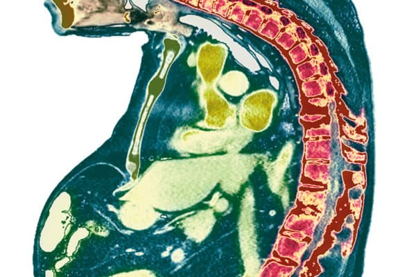 CT eines 74-jährigen Mannes mit Ankylosierender Spondylitis