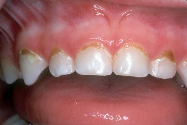Nahaufnahme der Zähne eines Kindes mit kariösen Läsionen an den oberen Frontzähnen.
