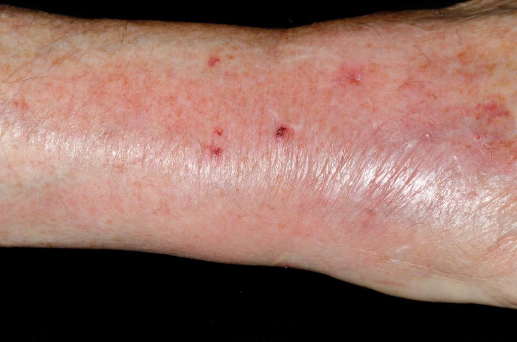 MODEL RELEASED. Red and inflamed skin on the wrist due to an infected cat bite in an 83 year old male patient