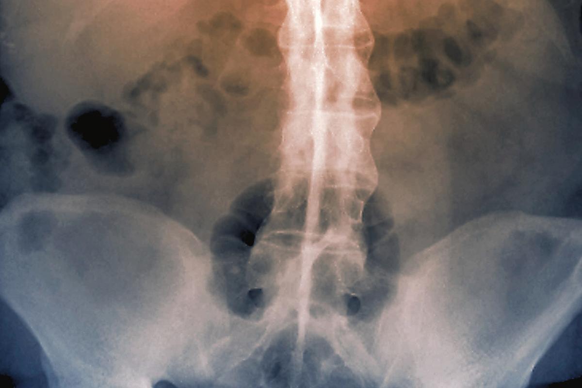 Spine in ankylosing spondylitis. Coloured frontal X-ray of the lumbosacral (lower) spine of a 56-year-old woman with ankylosing spondylitis. This is a condition where the spinal joints become progressively inflamed,and eventually the spine fuses. The severity of cases can vary from mild to severe and immobilising. Treatment is with physiotherapy and anti-inflammatory drugs. The pelvic bones are se