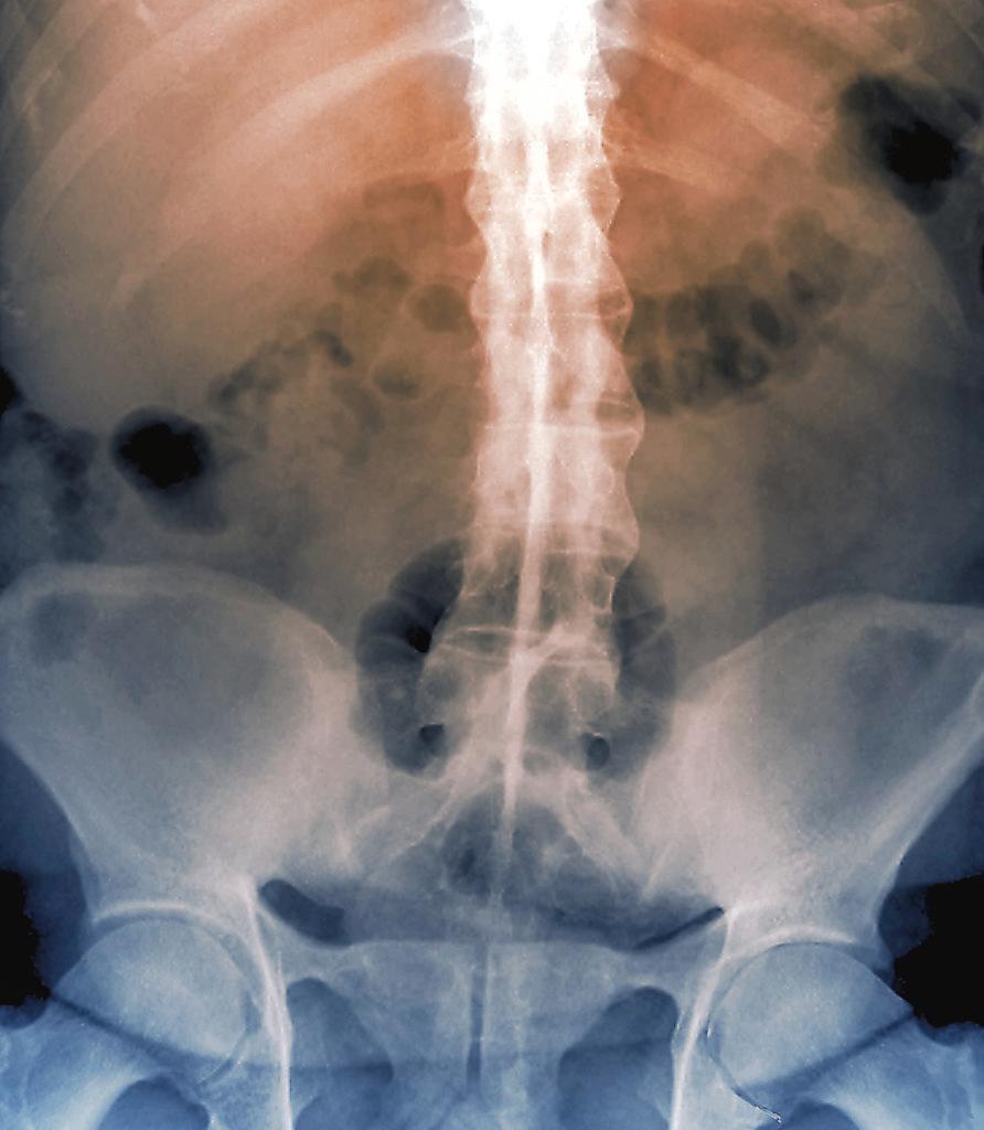Spine in ankylosing spondylitis. Coloured frontal X-ray of the lumbosacral (lower) spine of a 56-year-old woman with ankylosing spondylitis. This is a condition where the spinal joints become progressively inflamed,and eventually the spine fuses. The severity of cases can vary from mild to severe and immobilising. Treatment is with physiotherapy and anti-inflammatory drugs. The pelvic bones are se