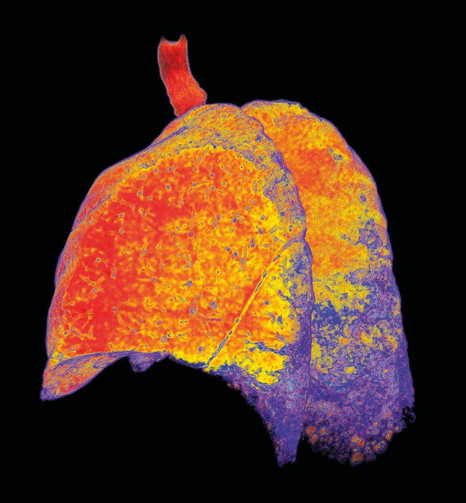 Interstitial lung disease. Coloured 3D computed tomography (CT) scan of a left side sectioned view of the lungs of a patient with interstitial lung disease (ILD). ILD is a group of lung diseases that affect the tissue in the alveoli (air sacs) of the lungs. Most of these diseases later develop fibrosis (the formation of thickened scar tissue) in the lungs. ILD results in loss of lung volume,impair