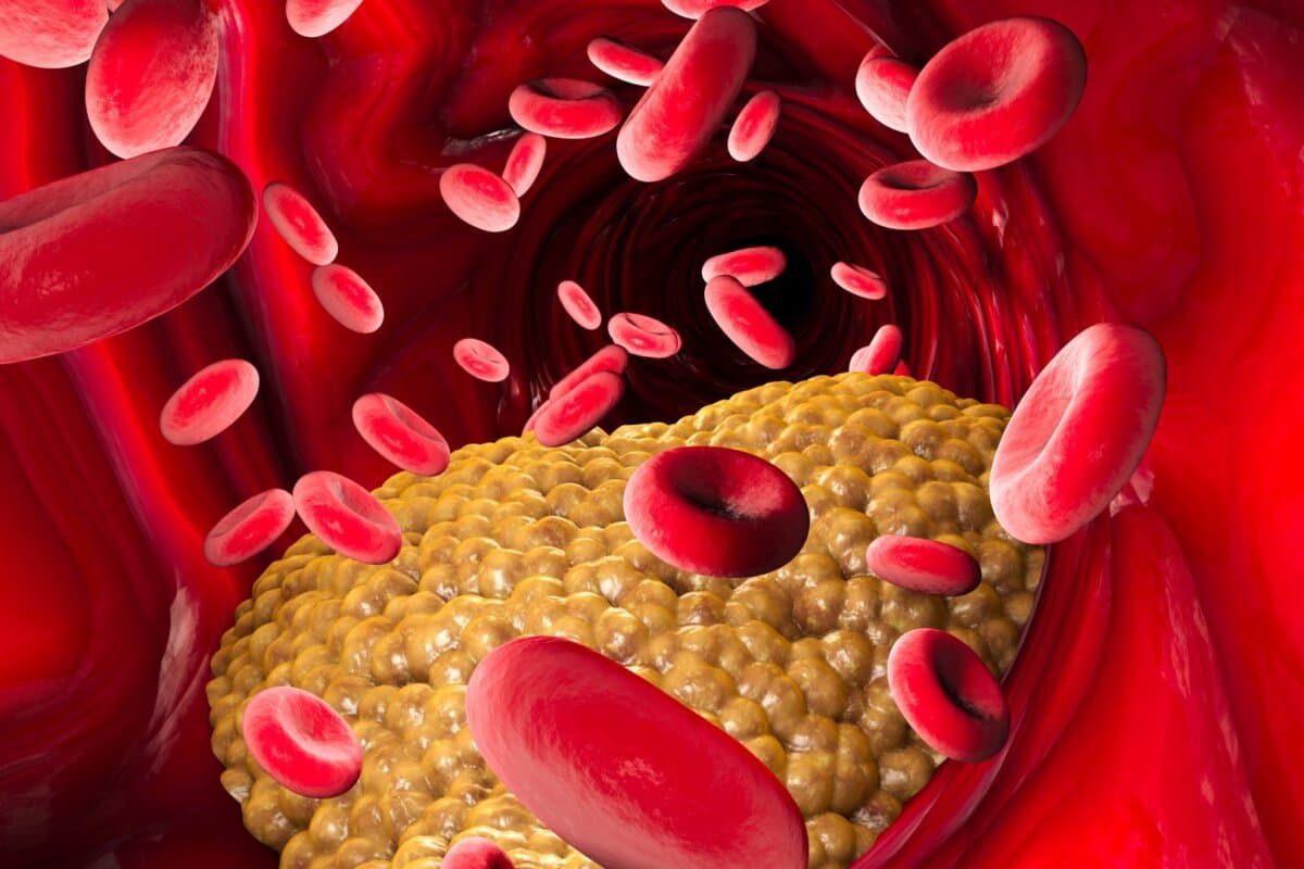 L'inclisiran a réduit le LDL à long terme dans des études