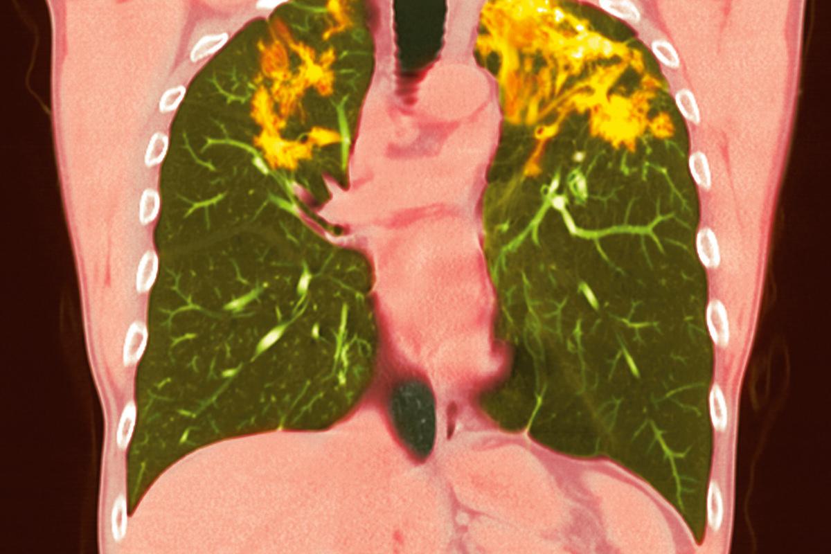 Die Sarkoidose-assoziierte Lungenfibrose verschlechtert den Verlauf deutlich.