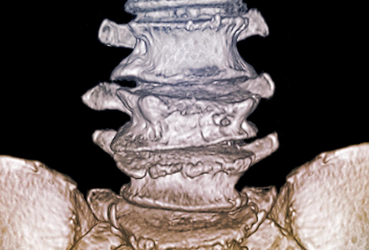 Bei der 71-jährigen GIOP-Patientin sieht man im 3D-CT-Scan eine Fraktur von L3.