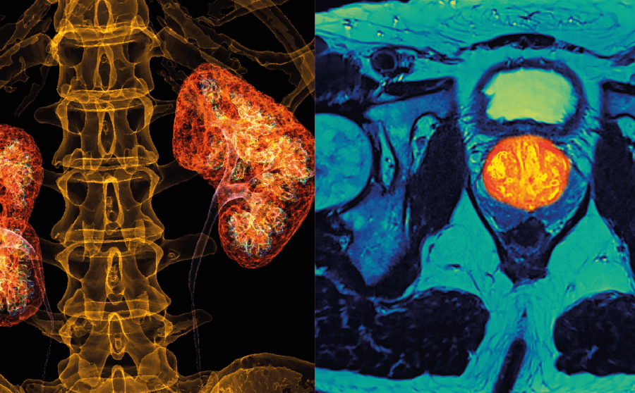 Carcinome à cellules rénales – Carcinome de la prostate