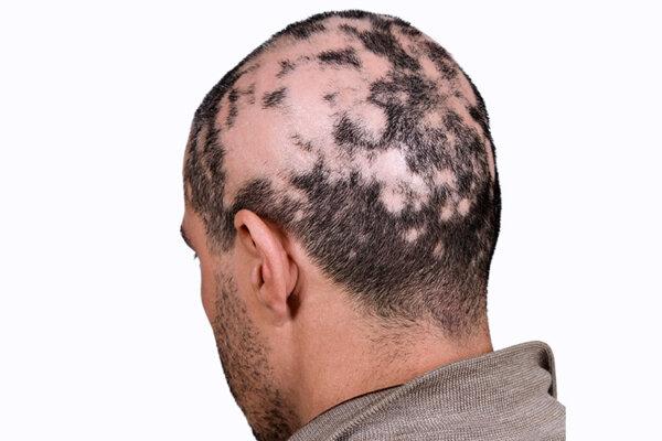 La pelade entraîne une chute circulaire des cheveux sur le cuir chevelu