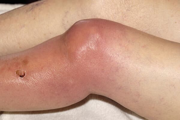 Septische Arthritis im Knie einer 88-jährigen Frau aufgrund einer Infektion mit MRSA.