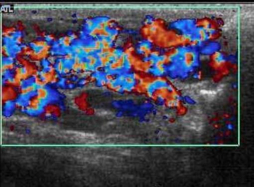 Scrotal ultrasonography of varicocele